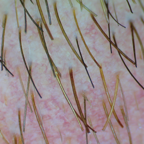 Firefly DE300 Wired Digital Polarizing Dermatoscope / Dermascope = 202-500