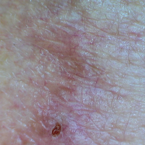 Firefly DE300 Wired Digital Polarizing Dermatoscope / Dermascope = 202-500